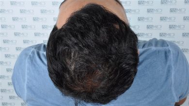 fue-hair-transplant (8)