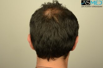 fue-hair-transplant (9)