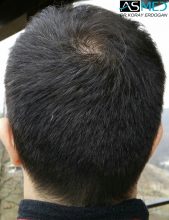 hair-transplant-asmed-istanbul (1)