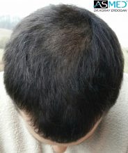 hair-transplant-asmed-istanbul (10)
