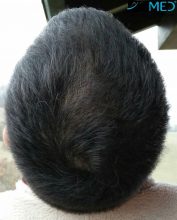 hair-transplant-asmed-istanbul (11)