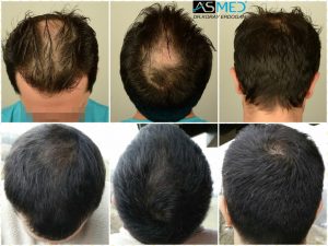 hair-transplant-asmed-istanbul (2)