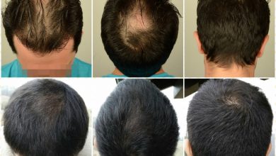 hair-transplant-asmed-istanbul (2)