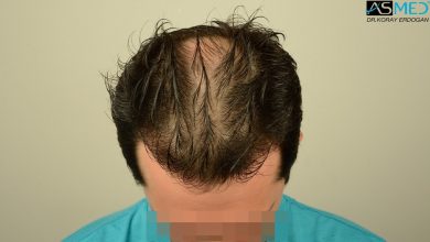 hair-transplant-asmed-istanbul (3)