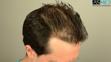 hair-transplant-asmed-istanbul (4)