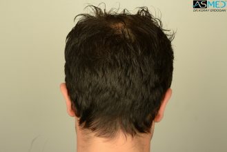 hair-transplant-asmed-istanbul (5)