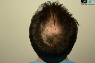 hair-transplant-asmed-istanbul (6)