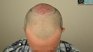 hair-transplant-asmed-istanbul (7)