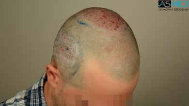 hair-transplant-asmed-istanbul (8)