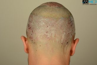 hair-transplant-asmed-istanbul (9)