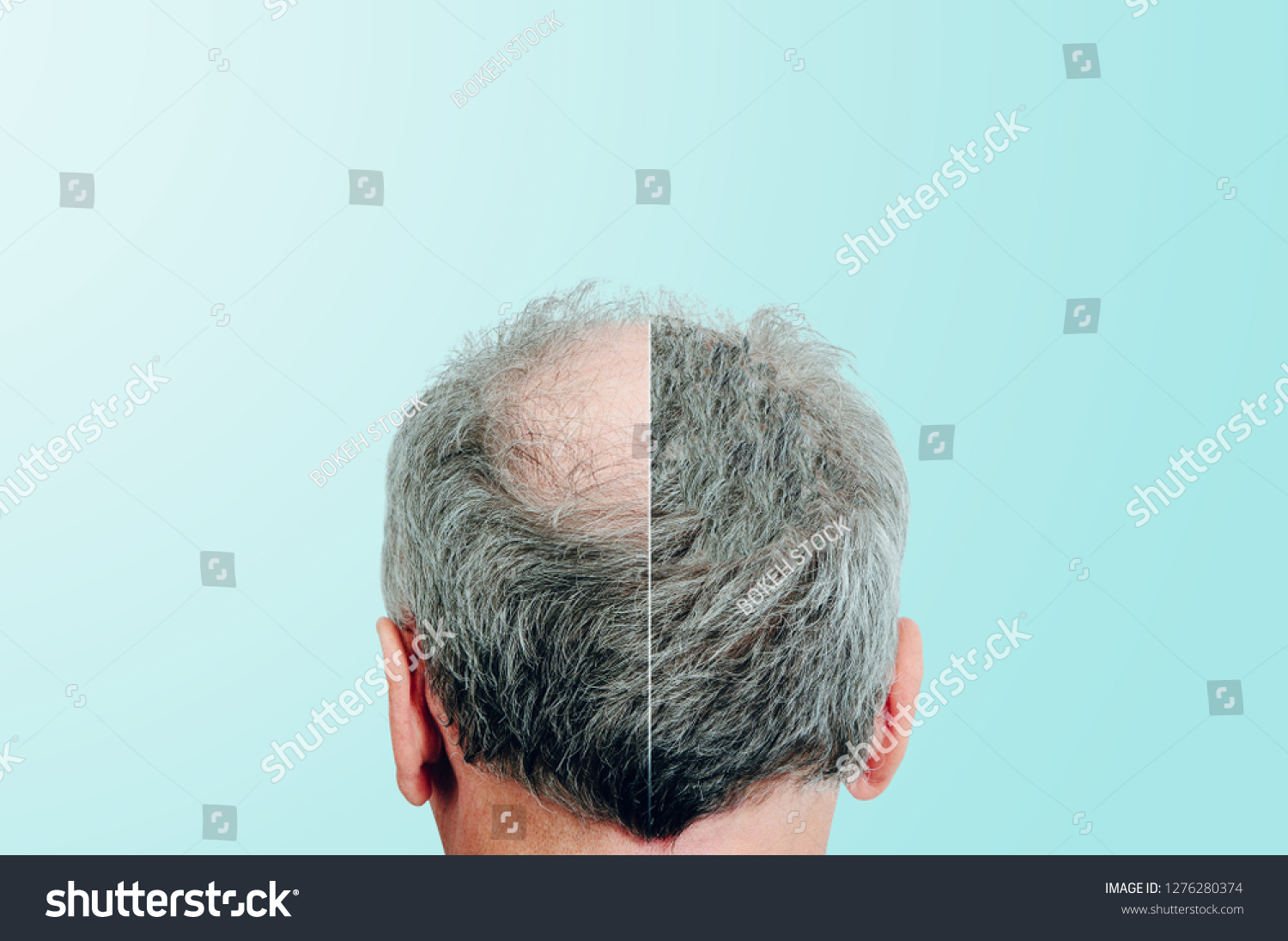 hair-transplant-before-and-after