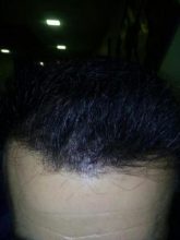 3250-grafts-hair-transplant-results (1)