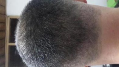3250-grafts-hair-transplant-results (10)