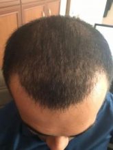3250-grafts-hair-transplant-results (11)
