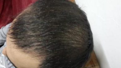 3250-grafts-hair-transplant-results (13)