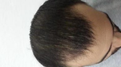 3250-grafts-hair-transplant-results (14)