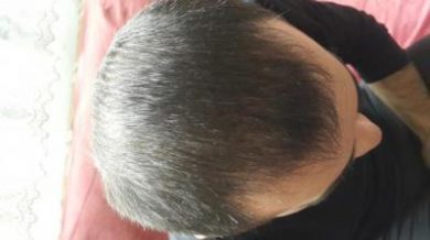 3250-grafts-hair-transplant-results (15)