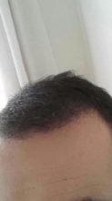 3250-grafts-hair-transplant-results (16)
