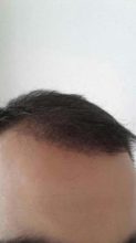 3250-grafts-hair-transplant-results (17)
