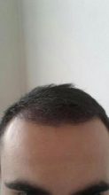 3250-grafts-hair-transplant-results (18)