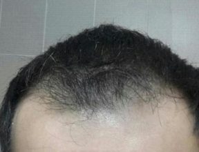 3250-grafts-hair-transplant-results (2)