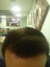 3250-grafts-hair-transplant-results (21)