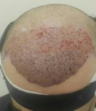 3250-grafts-hair-transplant-results (3)