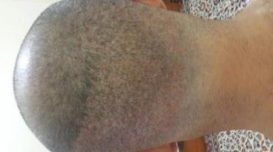 3250-grafts-hair-transplant-results (4)