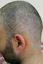 3250-grafts-hair-transplant-results (5)