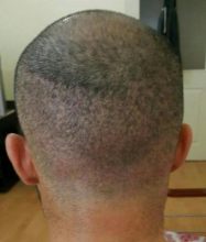 3250-grafts-hair-transplant-results (6)