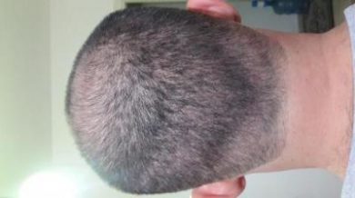 3250-grafts-hair-transplant-results (7)