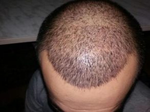 3250-grafts-hair-transplant-results (8)