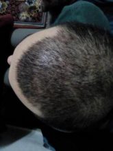 3250-grafts-hair-transplant-results (9)
