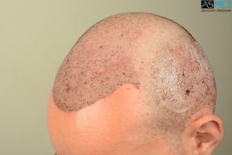 4000-grafts-hair-transplant (10)