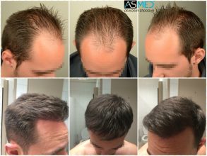 4000-grafts-hair-transplant (11)