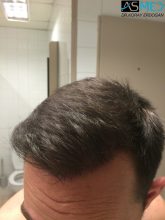 4000-grafts-hair-transplant (3)