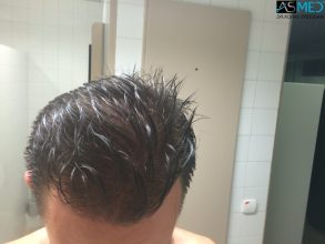 4000-grafts-hair-transplant (4)