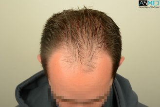 4000-grafts-hair-transplant (5)
