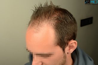 4000-grafts-hair-transplant (7)