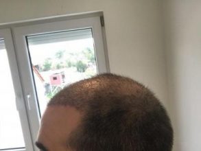 emrah-cinik-hair-transplant-center (10)