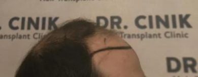 emrah-cinik-hair-transplant-center (11)