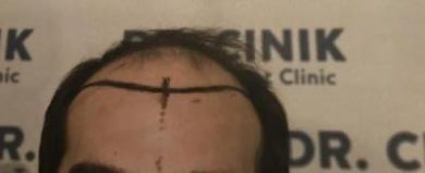 emrah-cinik-hair-transplant-center (12)