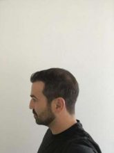 emrah-cinik-hair-transplant-center (14)