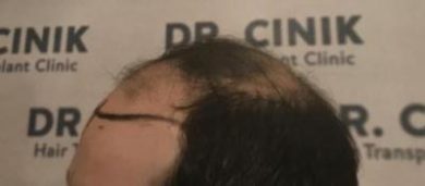 emrah-cinik-hair-transplant-center (18)