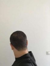 emrah-cinik-hair-transplant-center (19)