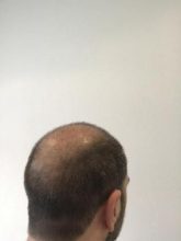 emrah-cinik-hair-transplant-center (20)