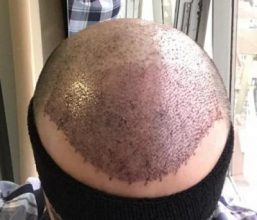 emrah-cinik-hair-transplant-center (22)