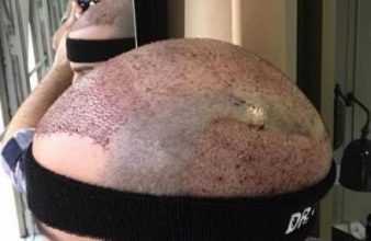 emrah-cinik-hair-transplant-center (23)