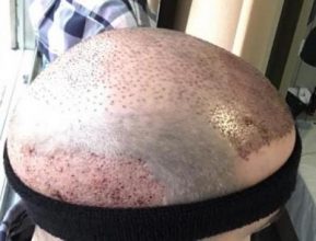 emrah-cinik-hair-transplant-center (24)