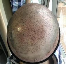 emrah-cinik-hair-transplant-center (25)